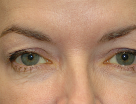 Surgery for Ptosis droopy eyelids