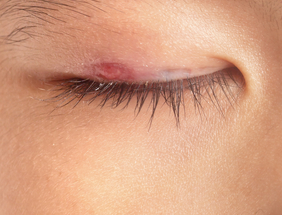 eyelid-lumps-bumps-tumors