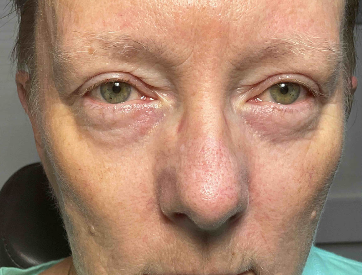 After Eyelid Surgery