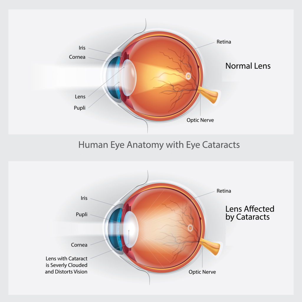 Cataracts page