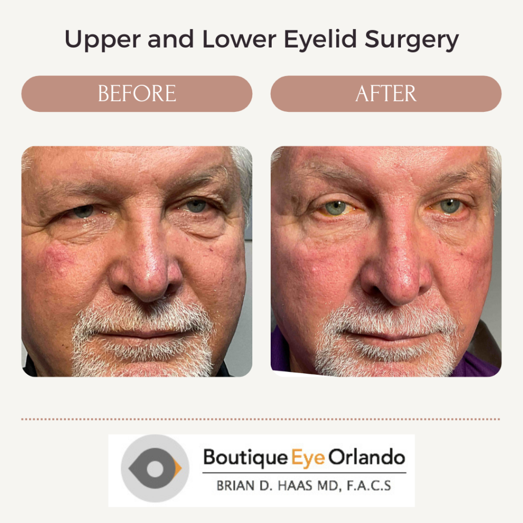 Bilateral Upper Lid Extended Ptosis Surgery with Bilateral lower Lid Blepharoplasty
