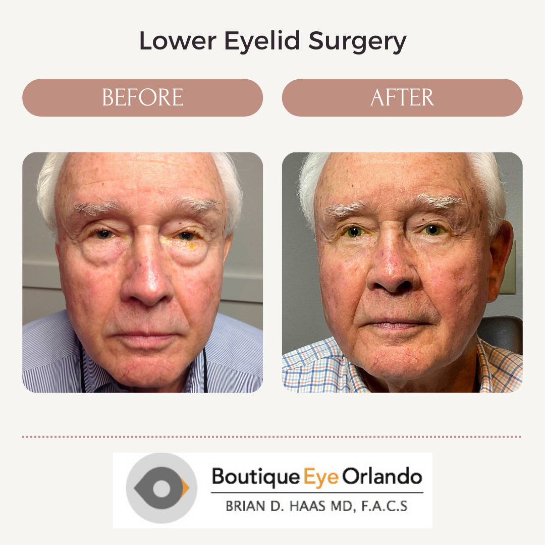 bilateral lower lid blepharoplasty