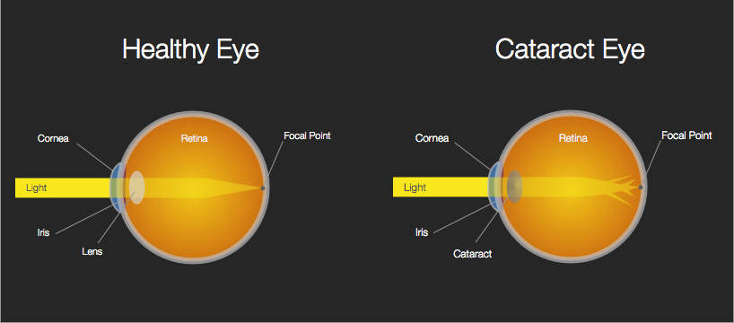 Before and after advanced cataract surgery