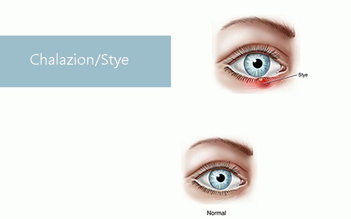 Chalazion/Stye