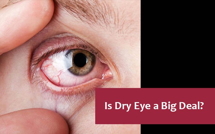 Orlando Eye Doctor Treats Dry Eyes