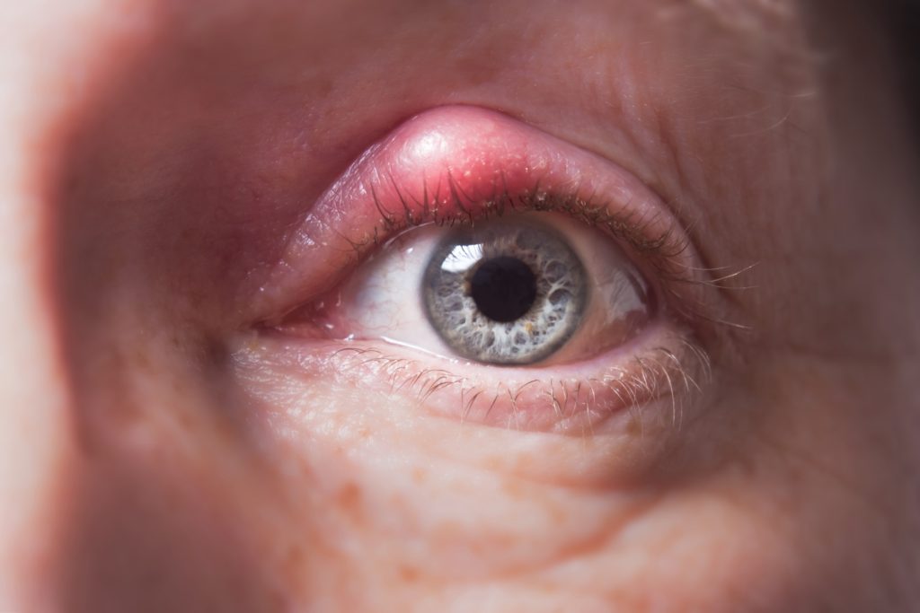 What is a Chalazion/Stye?